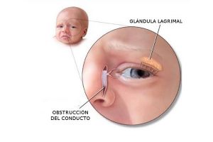 Especialistas en Obstrucción de Vía Lagrimal Oftalmólogos en México